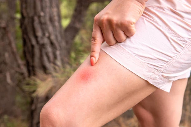 Какие бывают виды укусов разных насекомых, и как их отличить